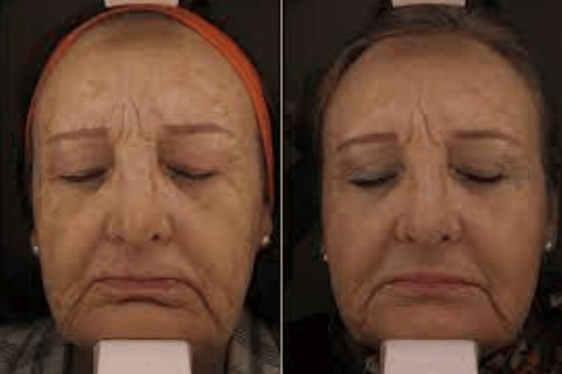 prp injection